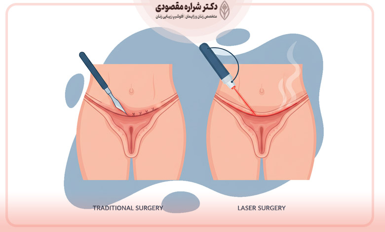 تفاوت لابیاپلاستی با لیزر و جراحی سنتی