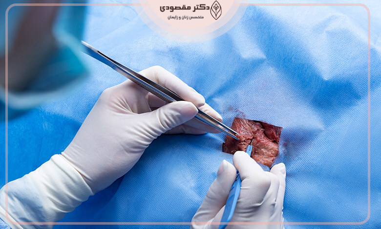 لابیاپلاستی با جراحی سنتی