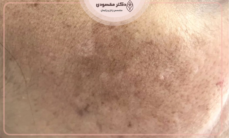 روشن شدن برخی از نواحی واژن