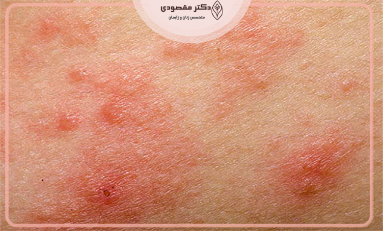 آلرژی پوست واژن