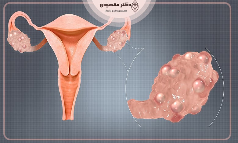 سندروم تخمدان پلی کیستیک
