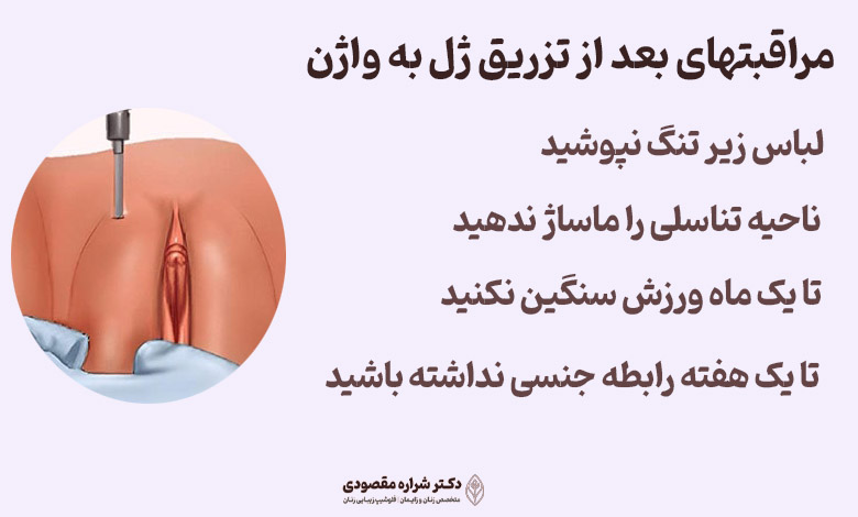 مراقبتهای بعد از تزریق ژل به واژن