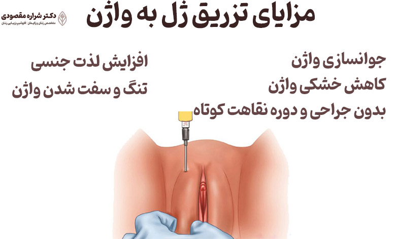 مزایای تزریق ژل به واژن چیست؟