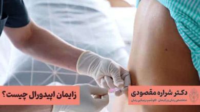 زایمان اپیدورال