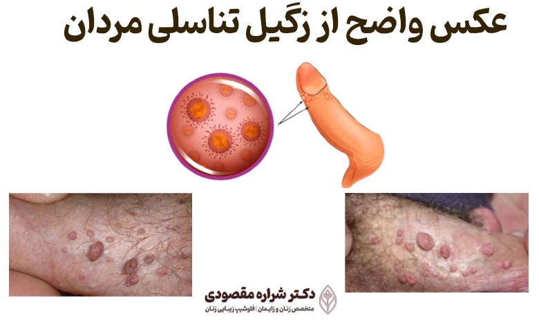 عکس واضح از زگیل تناسلی مردان