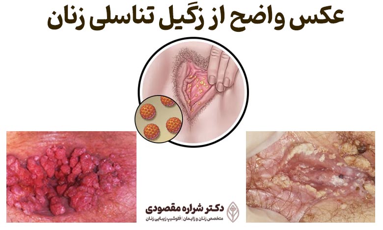 تصویر واضح از زگیل تناسلی زنان