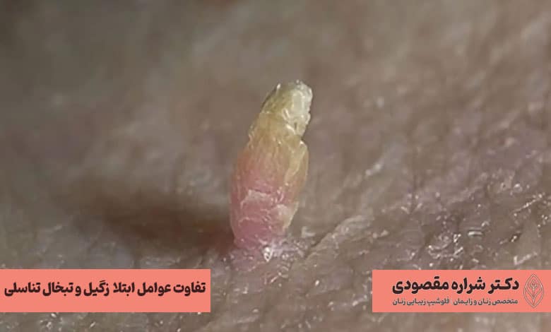 تفاوت زگیل و تبخال تناسلی از نظر عوامل ابتلا