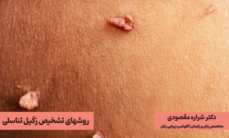 روشهای تشخیص زگیل تناسلی زنان