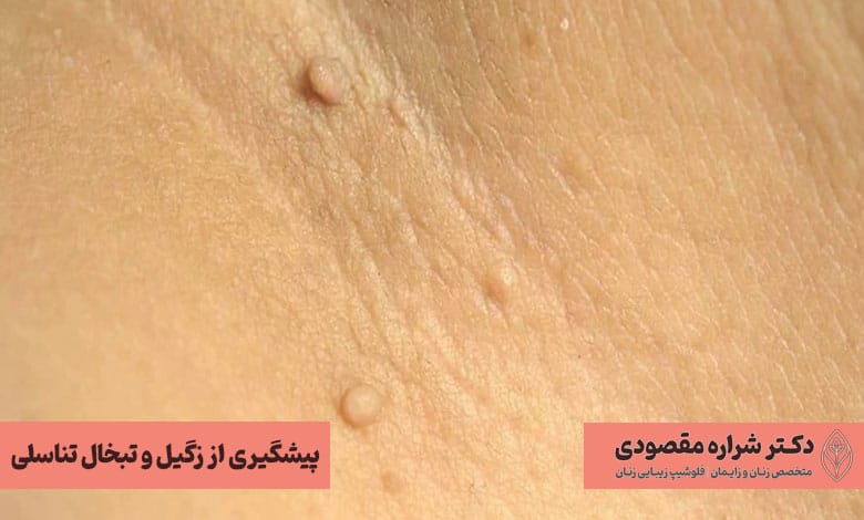 پیشگیری از زگیل و تبخال تناسلی