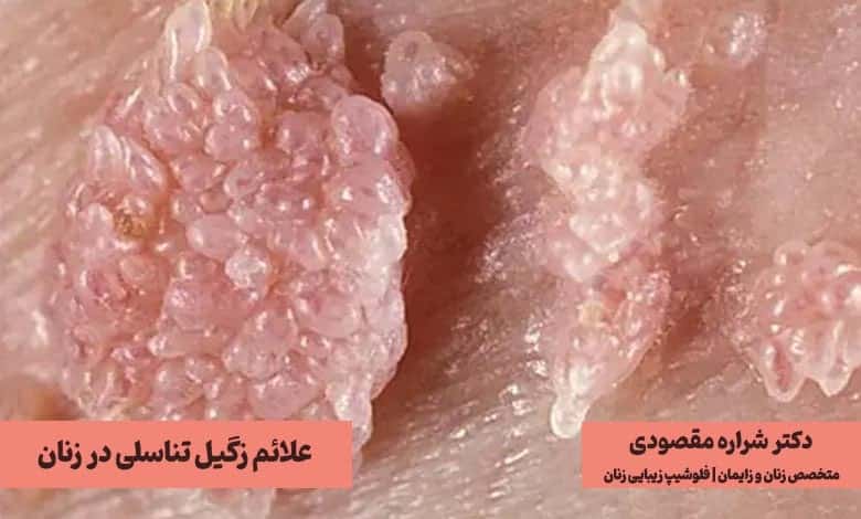 علائم زگیل تناسلی در زنان