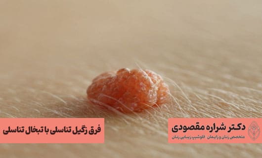 فرق زگیل تناسلی با تبخال تناسلی