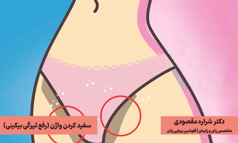 روشهای سفید کردن واژن