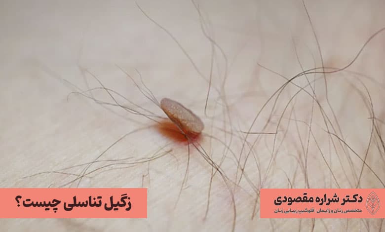  زگیل تناسلی چیست؟