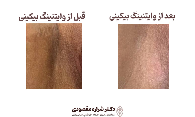 عکس قبل و بعد از وایتنینگ بیکینی