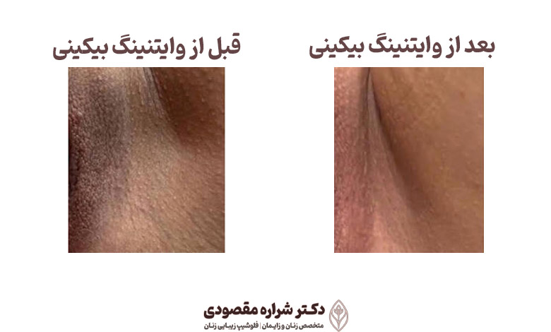 قبل و بعد از سفید کردن واژن