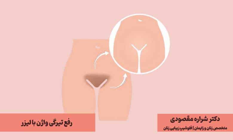 سفید کردن واژن با لیزر