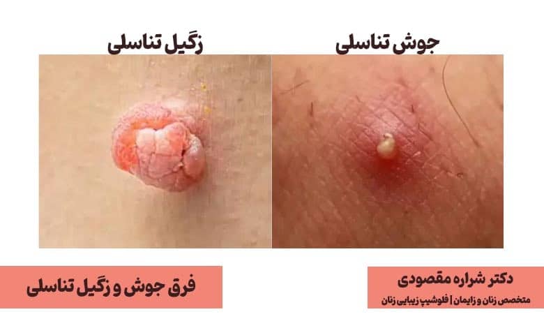 از کجا بفهمیم زگیل تناسلی داریم یا جوش؟ فرق جوش و زگیل تناسلی