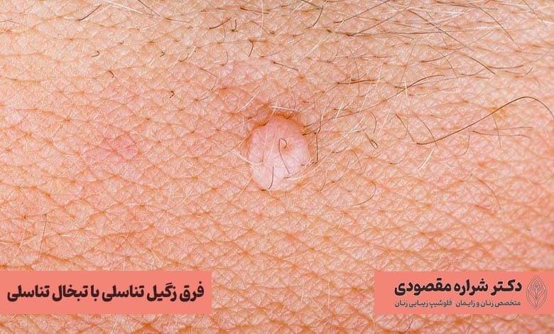 تفاوت زگیل تناسلی با تبخال تناسلی از نظر علائم