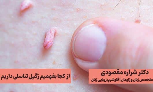 از کجا بفهمیم زگیل تناسلی داریم؟
