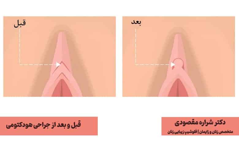 عمل جراحی زیبایی هودکتومی