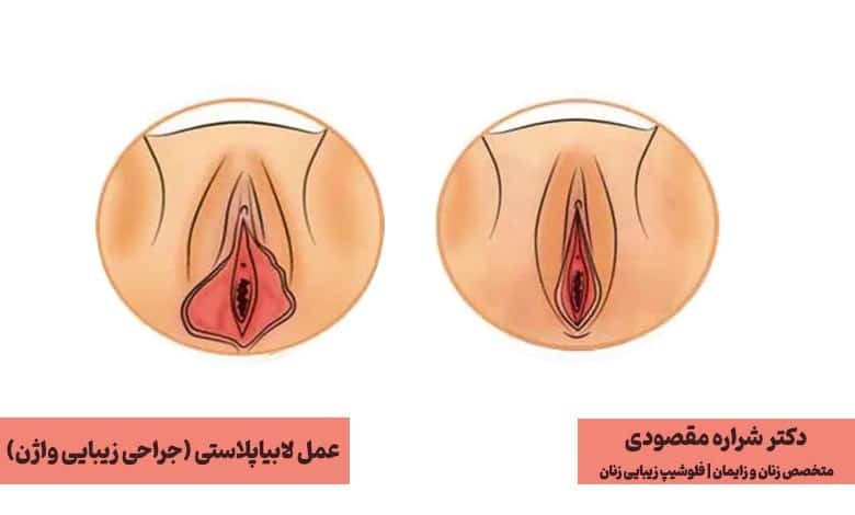 عمل لابیاپلاستی؛ رایجترین عمل جراحی زیبایی واژن