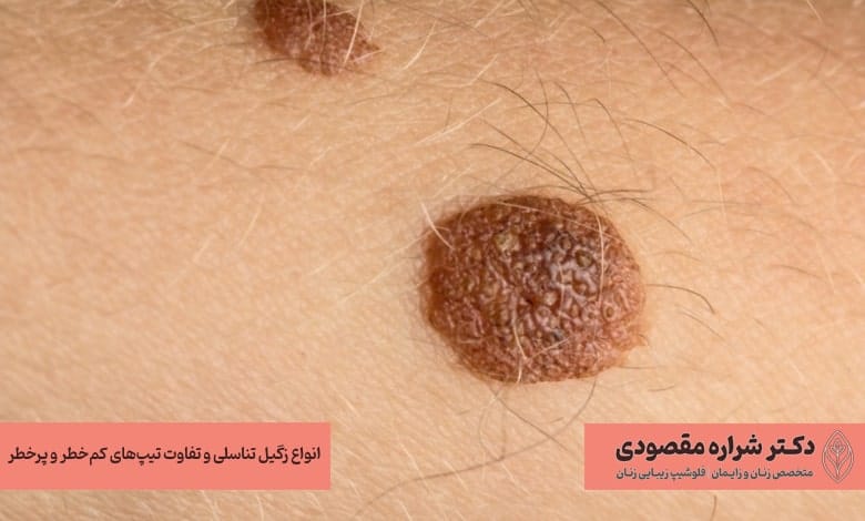 انواع زگیل تناسلی خطرناک