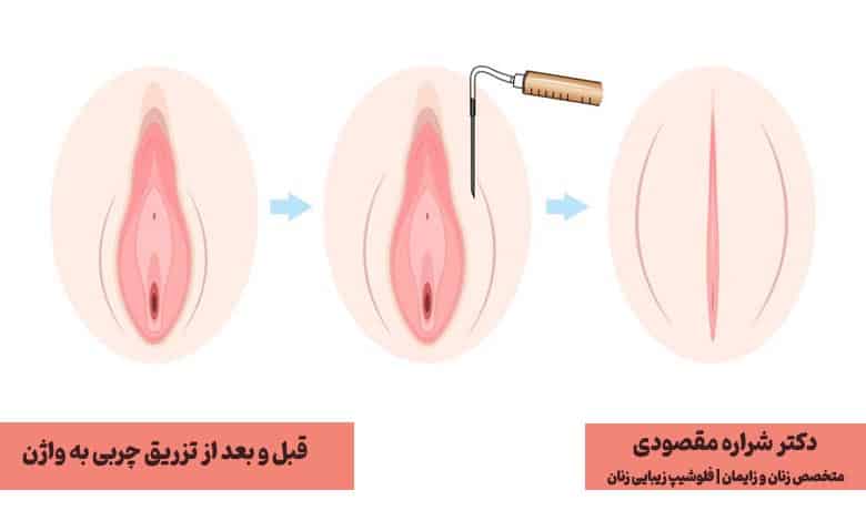 تزریق چربی به واژن 