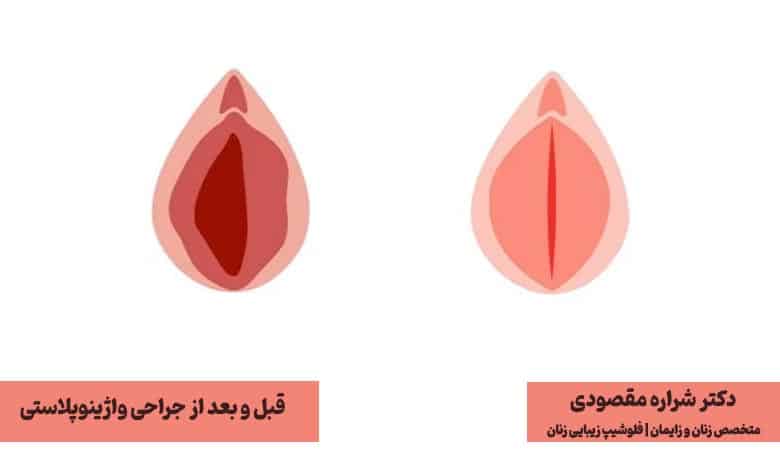 واژینوپلاستی