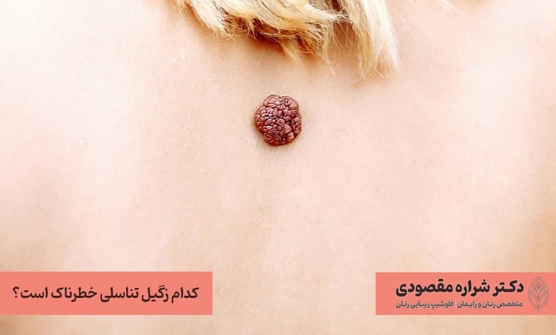 زگیل تناسلی خطرناک چیست