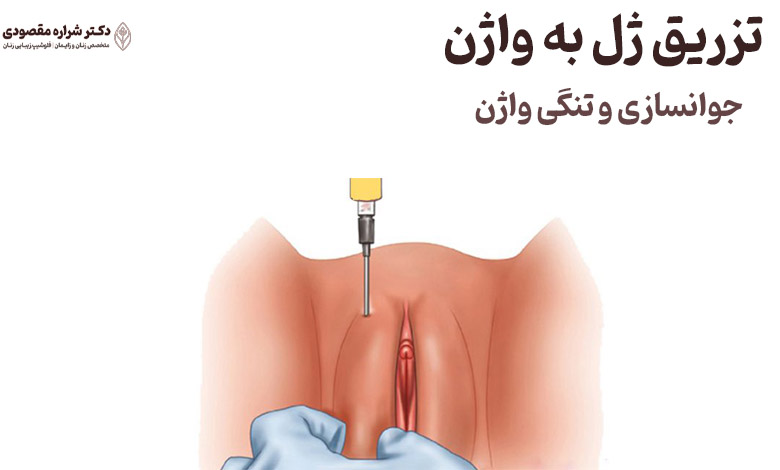 تزریق ژل به واژن چیست