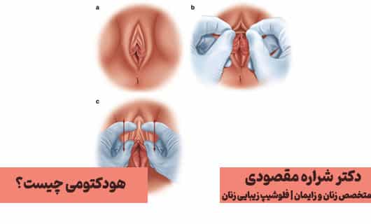 هودکتومی چیست