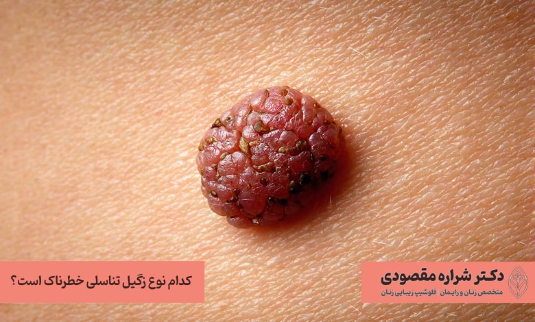 کدام نوع زگیل تناسلی خطرناک است