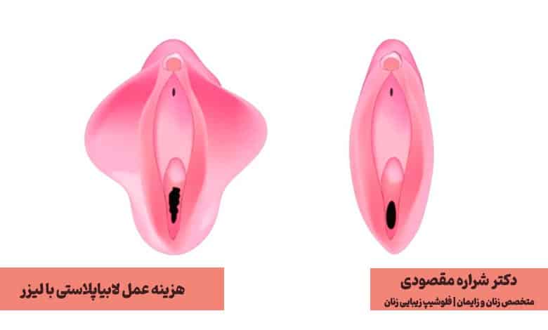 هزینه عمل لابیاپلاستی با لیزر