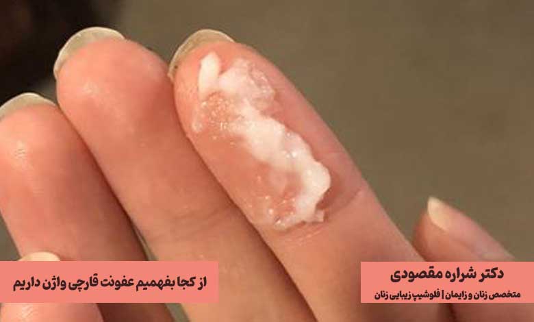 از کجا بفهمیم عفونت قارچی واژن داریم؟ (روشهای تشخیص)
