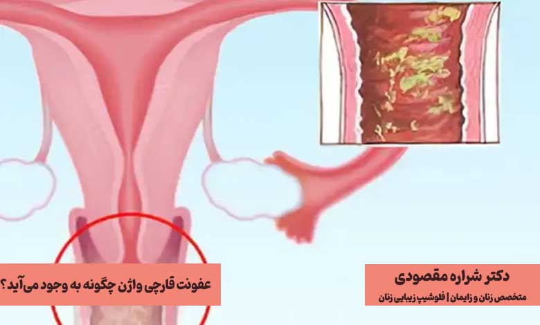 عفونت قارچی واژن چگونه به وجود میآید؟ (دلایل)