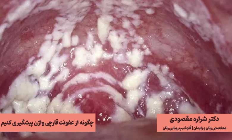 چگونه از بروز عفونت قارچی واژن پیشگیری کنیم؟