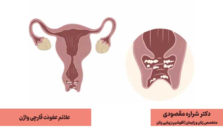 علائم عفونت قارچی واژن