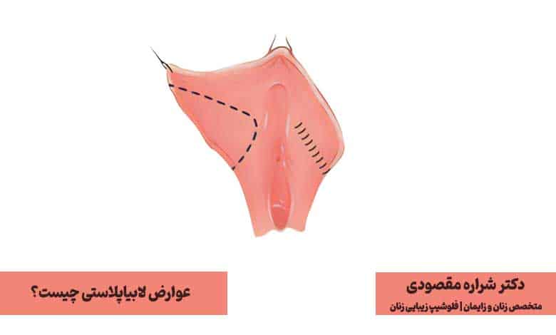 خطرات و عوارض لابیاپلاستی چیست