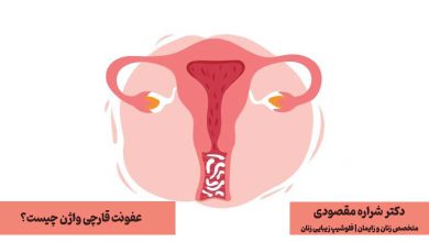 عفونت قارچی واژن