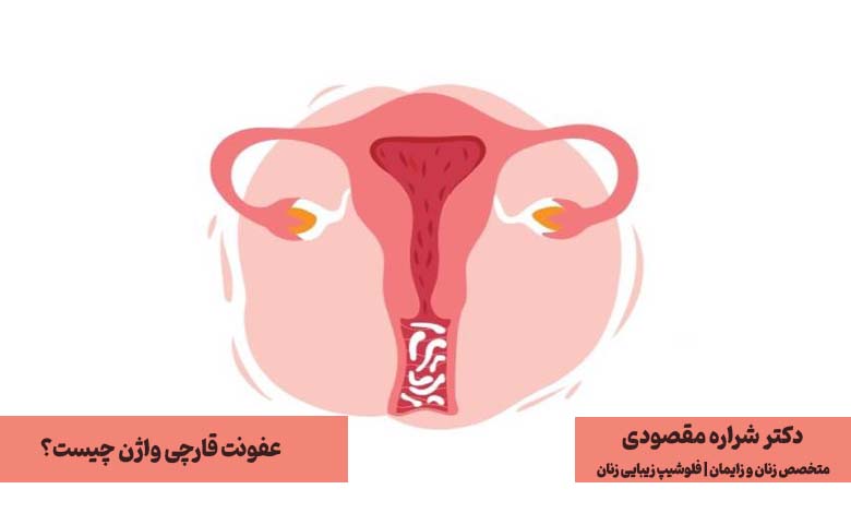 عفونت قارچی واژن