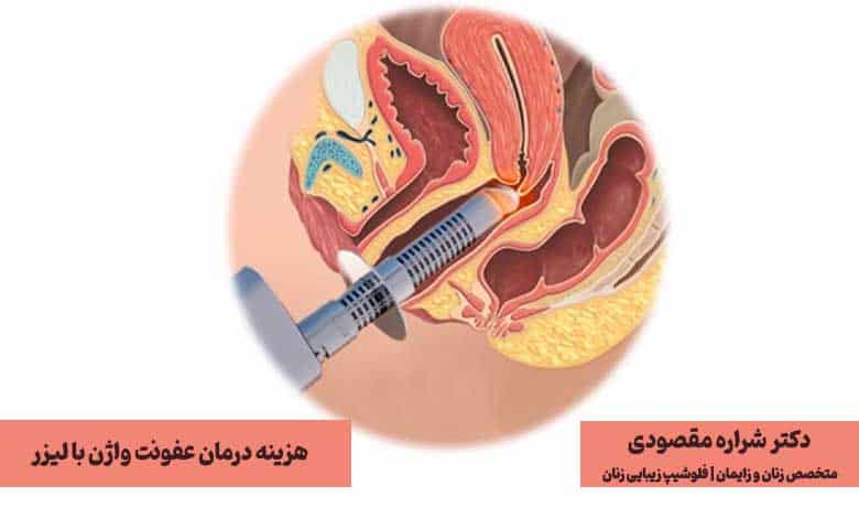هزینه درمان عفونت واژن با لیزر