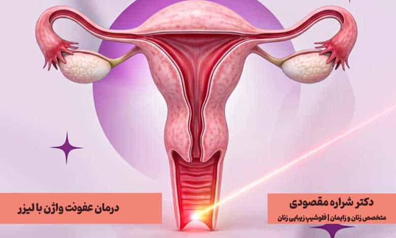 لیزر عفونت واژن؛ درمان عفونت واژن با لیزر + هزینه 1404