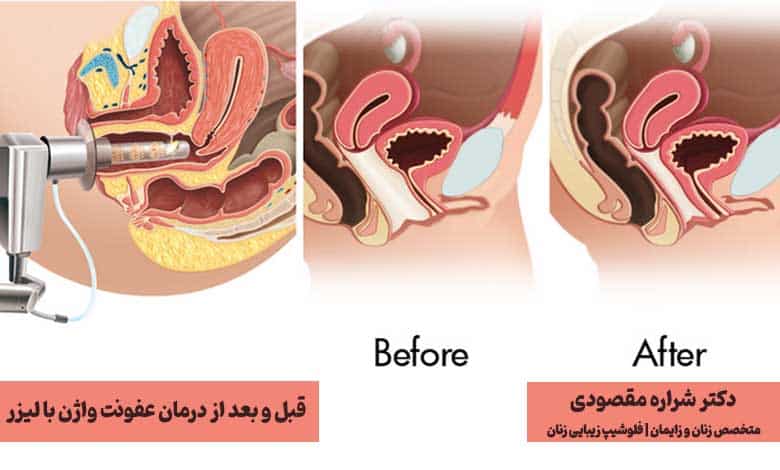 نحوه عملکرد لیزر عفونت واژن - عکس قبل و بعد از درمان
