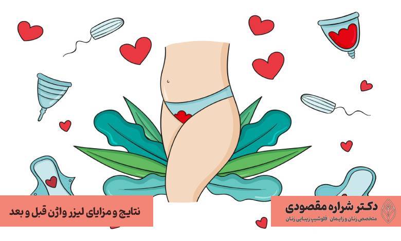 نتایج و مزایای لیزر واژن قبل و بعد