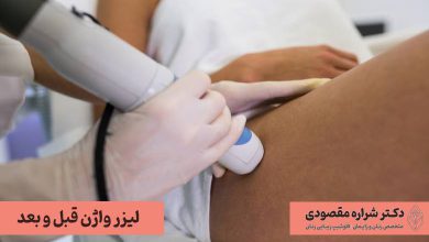 لیزر واژن قبل و بعد