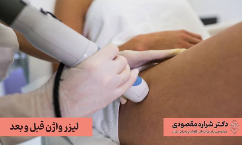 لیزر واژن قبل و بعد