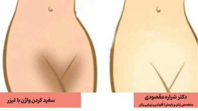 سفید کردن واژن با لیزر