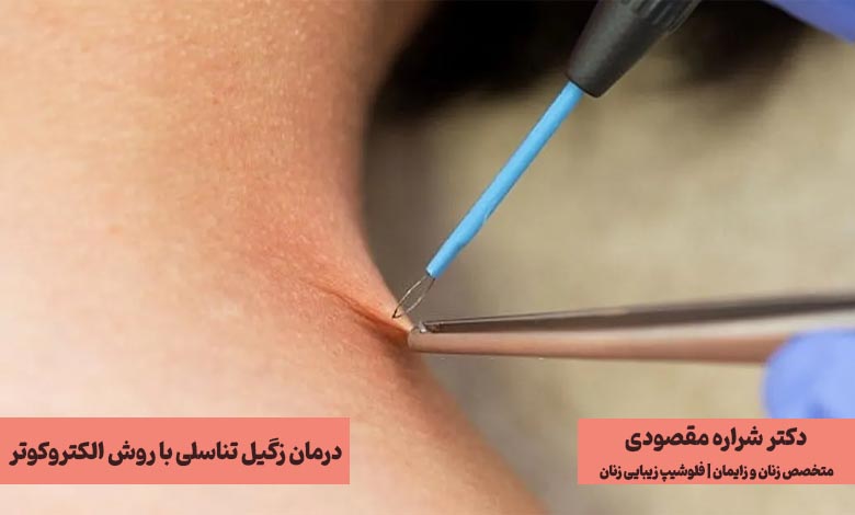 عکس درمان زگیل تناسلی با روش الکتروکوتر - سوزاندن زگیل تناسلی