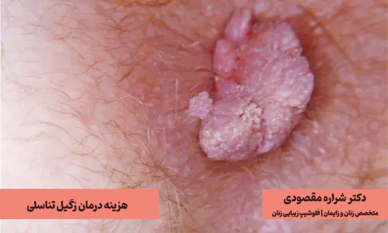 هزینه درمان زگیل تناسلی