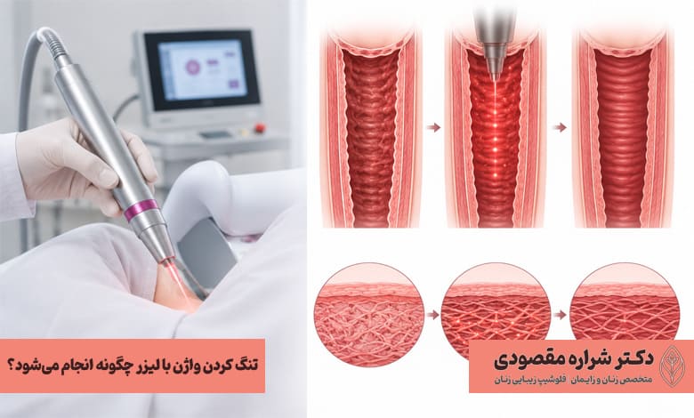 تنگ کردن واژن با لیزر چگونه انجام میشود؟